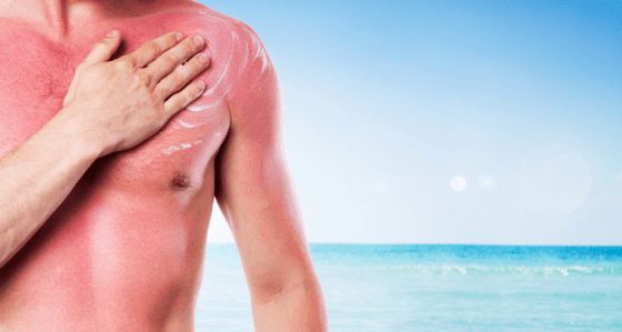 Remedios caseros para Tratamientos Calmante Sunburn Naturally