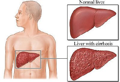 Remedios caseros para el hígado