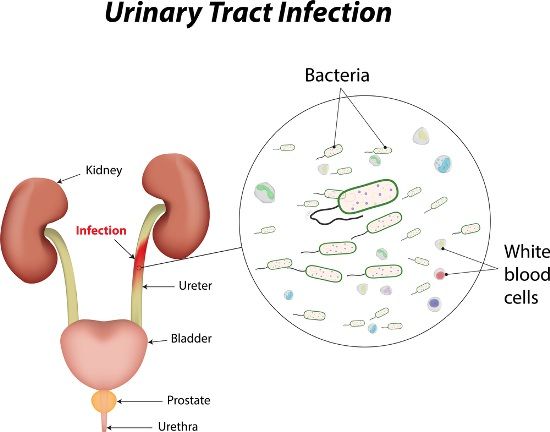 Remedios caseros para la infección urinaria del tracto urinario Infección infusiones