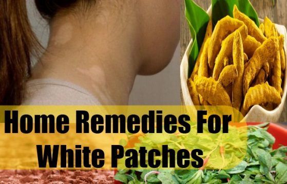 Remedios caseros para las manchas blancas en la piel