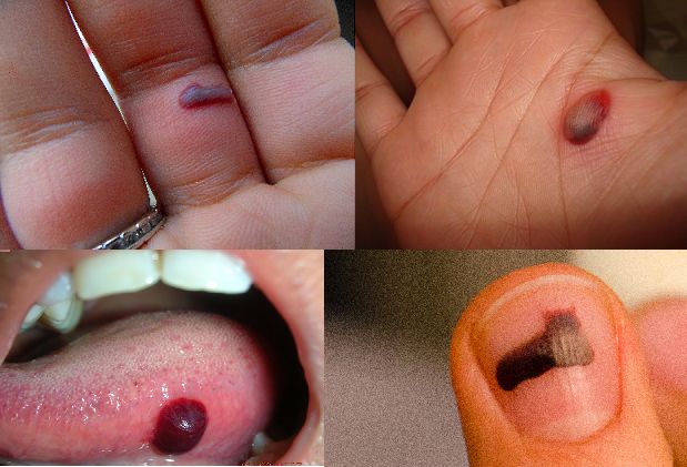 Remedios caseros para deshacerse de ampollas de sangre