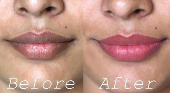 Remedios caseros para deshacerse de los labios oscuros Naturalmente