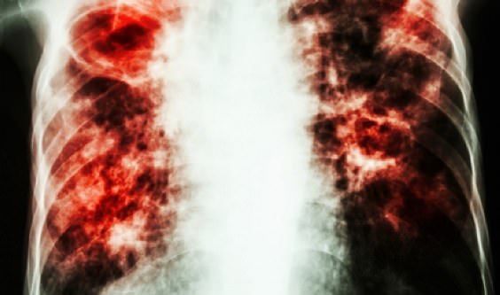 Los remedios caseros para tratar el trastorno de la fibrosis pulmonar