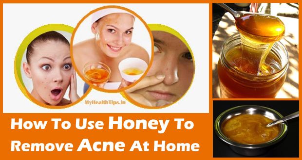 Miel para el acné