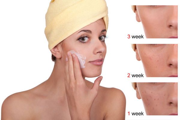 ¿Cómo evitar las cicatrices del acné naturalmente después de acné