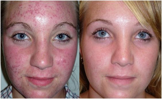 Cómo desaparecer las cicatrices del acné? (Incluyendo los remedios caseros)