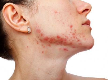 ¿Cómo deshacerse del acné
