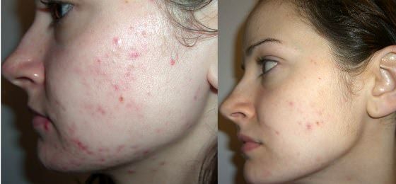 ¿Cómo deshacerse del acné en 1 día