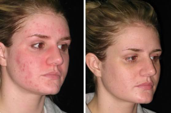 ¿Cómo deshacerse del acné naturalmente Remedios caseros