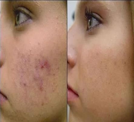 ¿Cómo deshacerse de las cicatrices del acné