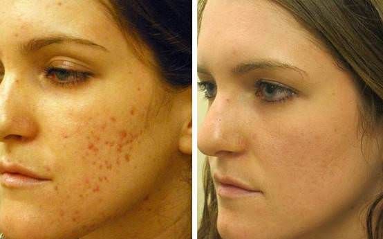 ¿Cómo deshacerse de las cicatrices del acné naturalmente sin productos químicos