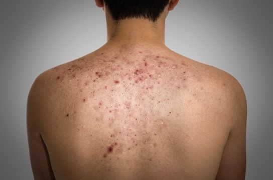 ¿Cómo deshacerse de bacne y bacne Tratamiento natural Cicatrices