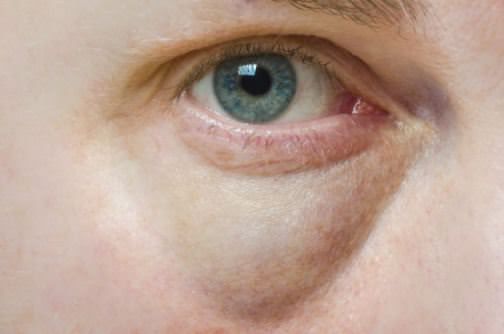 ¿Cómo deshacerse de las bolsas bajo los ojos rápidos