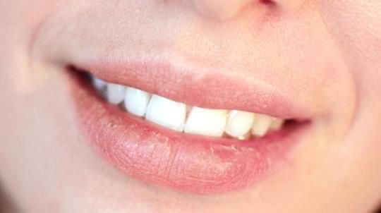 ¿Cómo deshacerse de los labios agrietados Uso de remedios caseros
