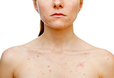 ¿Cómo deshacerse de acné de pecho rápido (remedios caseros)