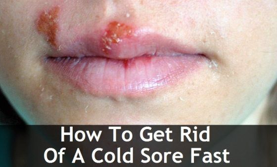 ¿Cómo deshacerse de herpes labial rápido