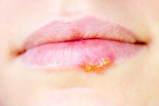¿Cómo deshacerse de herpes labial remedios doloridos