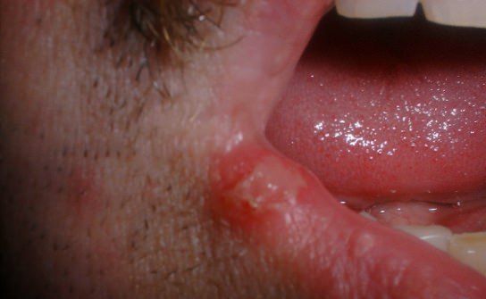 ¿Cómo deshacerse de herpes labial y ampollas Fiver