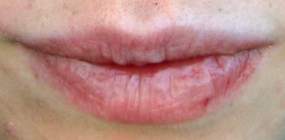 ¿Cómo deshacerse de los labios agrietados dolorosas rápido y de forma natural?