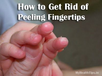 ¿Cómo deshacerse de la peladura Fingertips
