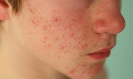 ¿Cómo deshacerse de acné en la adolescencia?