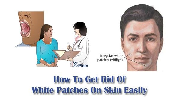 ¿Cómo deshacerse de blancos Parches On Skin