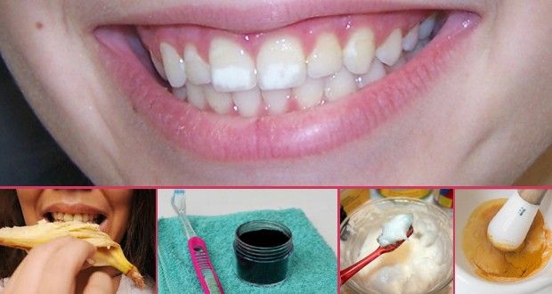 Deshacerse de las manchas blancas en los dientes