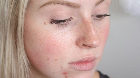 ¿Cómo deshacerse de Zits Ovenight Fast