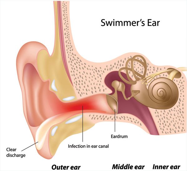 Cómo eliminar el agua de los oídos después de nadar o de baño (remedios caseros)
