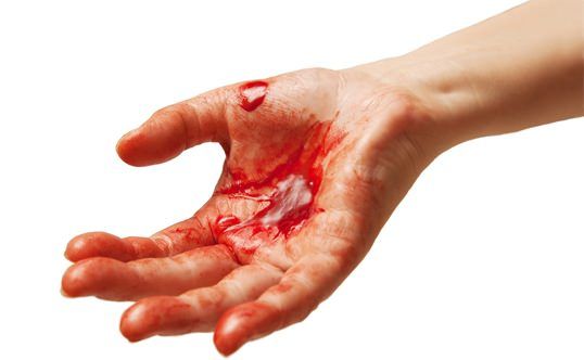 Cómo detener el sangrado de los cortes y hemorragias internas