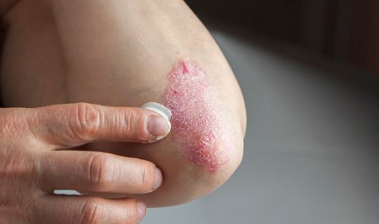Cómo tratar el eczema de forma natural