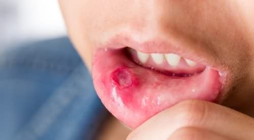 Cómo tratar las úlceras bucales o aftas dolorosas?