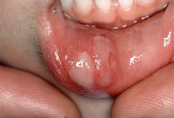 Cómo tratar las úlceras?