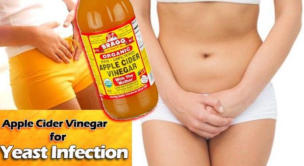 Vinagre de manzana para la infección por levaduras