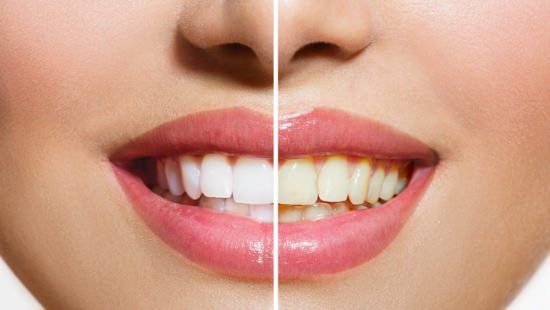 Cómo usar peróxido de hidrógeno para blanquear los dientes?