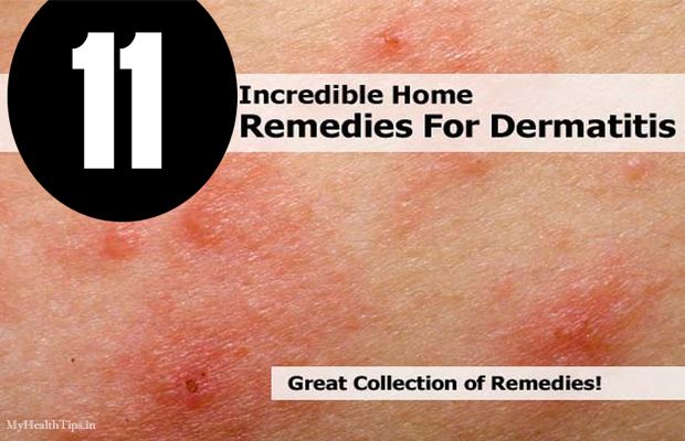 Remedios caseros increíbles para la dermatitis