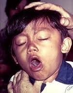 Un niño con tos ferina. La enfermedad causa ataques de tos violentos que son difíciles de controlar.