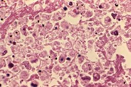Una mirada microscópica en el tejido pulmonar infectado con los legionarios` bacteria. 