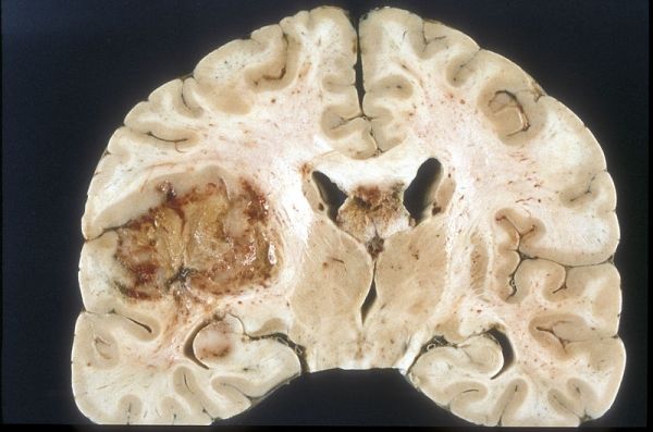 Missing gen relacionado con el cáncer cerebral agresivo