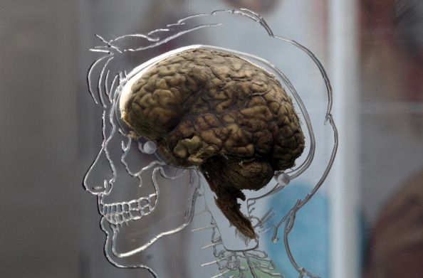 Los investigadores han encontrado más pruebas de que los depósitos de una sustancia llamada amiloide están relacionados con la enfermedad de Alzheimer`s disease.