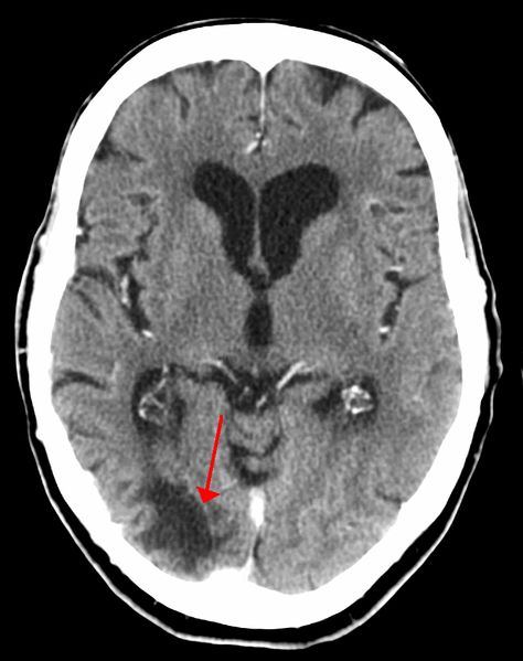 Un TAC que muestra los efectos de un derrame cerebral. El área oscurecida por debajo del puntero es la zona donde se produjo el accidente cerebrovascular.