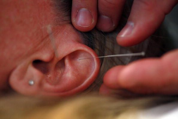 Ayudas de acupuntura del oído en la pérdida de peso