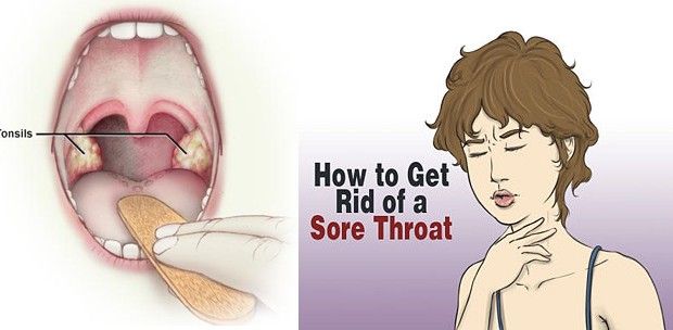 Siete maneras de forma natural de deshacerse de su dolor de garganta rápidamente