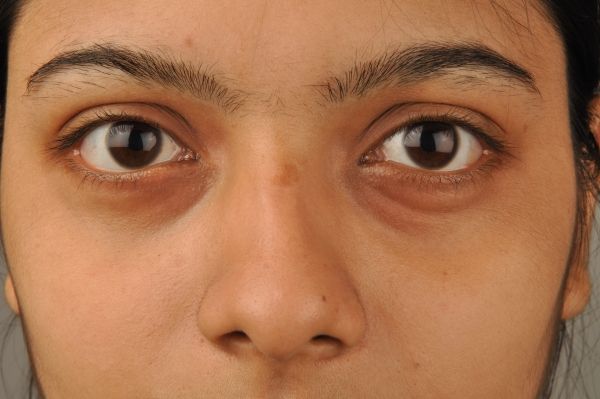 Hay varios factores que pueden causar las ojeras debajo de los ojos