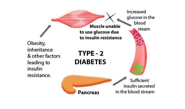 Los efectos a corto plazo de la diabetes tipo 2