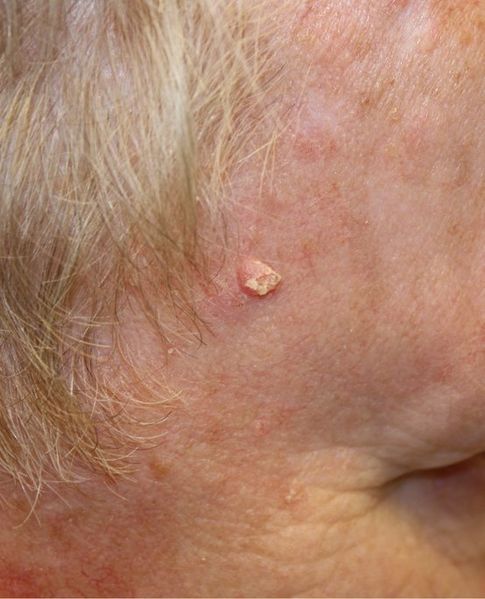 El carcinoma de células escamosas, un tipo de cáncer de piel
