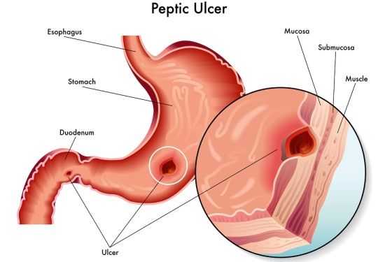Úlcera de estómago Síntomas Cómo comprobar síntomas de la úlcera de estómago