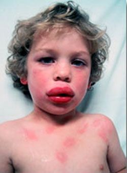 Los niños expuestos a la proteína de maní en la infancia son un 20% más de probabilidades de desarrollar una alergia al maní