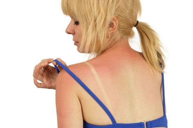Las quemaduras de sol Tratamiento Cómo tratar quemaduras de sol de la piel