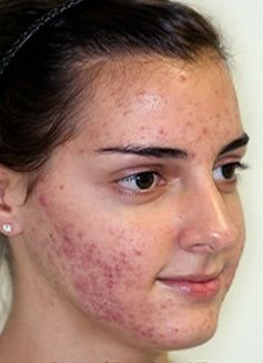 El acné puede ser una circunstancia embarazosa para los adolescentes